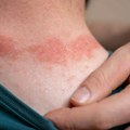 "Zimski osip" se vratio: Ovo je najbolje rešenje dermatologa da prestanete da se češete i trljate perutanje