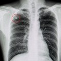 Patio od jakog kašlja, rekli mu da ima tumor, a onda je usledio novi šok: "Kad su ga izvukli, smejali su se"