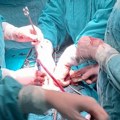 Užički hirurzi oborili evropski rekord – odstranili tumor prostate težak oko pola kilograma
