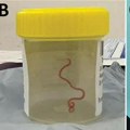 Ljekari u mozgu Australke pronašli živog crva od osam centimetara