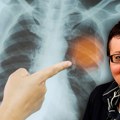 Херпес, другачији испљувак, модре усне: Мало познате симптоме упале плућа открива истакнути пулмолог
