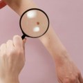 Muškarci i žene drugačije obolevaju od melanoma, evo šta kažu stručnjaci Zašto je važno pravilno zaštititi kožu od…