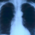 U Srbiji od raka pluća svaka dva sata umre jedna osoba, glavni faktor rizika - pušenje