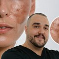Zašto agresivni tretmani pogoršavaju fleke na licu: Pravila za uklanjanje melazme i hiperpigmentacije bez kontraefekta