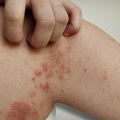 Impetigo se širi po Jadranu; Lekari upozoravaju: "Pridržavajte se ovih pravila"