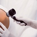 Preventivni pregledi otkrili sumnju na 33 melanoma – prof. dr Tiodorović: Rana dijagnostika spasava život