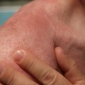 Ovaj rasprostranjen virus direktno utiče na nastanak karcinoma