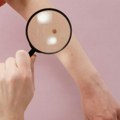 Ne ignorišite promene na mladežima: Evo kada treba posetiti dermatologa
