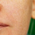 Kako smanjiti proširene pore na licu, prema dermatolozima