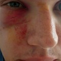 Optužbe o nasilju policije: Svedočenja povređenih na protestima u Srbiji
