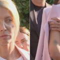 Odbornica Tatjana Mićić dala izjavu u PS Novi Beograd o incidentu sa Šapićem, pokazala povrede