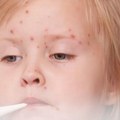 Чак 7 деце вртићког узраста има морбиле: Опасност од ширења заразе посебно велика у обдаништима 6 невакцинисано
