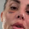 U Beogradu poljubila protivnicu u usta i pozirala kod Zvezdinog grba, sad se javila sa modricom ispod oka