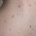 Male boginje ponovo potvrđene u Srbiji: "Batut" upozorava roditelje pred početak škole