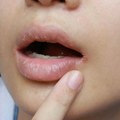 Suva usta ne moraju da budu samo zbog hladnoće! Jasni simptomi su alarm za 5 ozbiljnih bolesti - jedan je bol u grlu