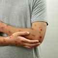 U Severnoj Makedoniji prvi put potvrđena dva slučaja majmunskih boginja