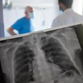 Pušenje izaziva karcinom pluća, Đerlek: Srbija će u najskorije vreme organizovati skrining na rano otkrivanje te bolesti