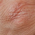 Sve što treba da znate o atopijskom dermatitisu