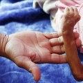 Gotovo polovina jemenske djece mlađe od pet godina neuhranjena