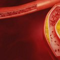 Nutricionisti: Ako želite brzo da snizite holesterol, češće jedite tri namirnice