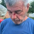 Kancelarija za KiM: Srbin na Kosovu pretučen dok je pokušao da odbrani sina od napadača