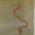 „Živ i migolji se“ – hirurzi iz mozga žene izvadili živog crva dugačkog osam centimetara