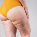 Celulit: Mala udubljenja, veliki problemi i još veća zarada
