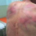 (Foto) Pretučen Srbin kod Zubinog Potoka: "Kosovska policija me je odvela u šumu, vezali su me za drvo i udarali crevom"