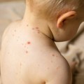 Ministarstvo zdravlja zbog malih boginja najavilo hitnu reviziju vakcinalne kartoteke
