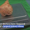 Izvadili najteži kamen iz bubrega: Rekord lekarskog tima iz Šri Lanke