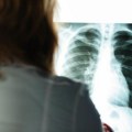 Došla kod lekara bez simptoma, otkrili joj metastaze na plućima: Preventivni pregled možda će spasiti život još jednoj…