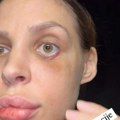 (Video) "oko oka je ogromna rupa, sve je smrskano": Nataša Šavija pokazala stravične povrede koje joj je Karić naneo: Ovako…