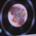 Rano otkrivanje melanoma povećava šanse za uspešno izlečenje