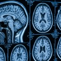 Nova veštačka inteligencija može da otkrije o čemu razmišljate na osnovu snimka mozga