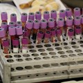 Nova analiza krvi mogla bi da otkrije rizik od najčešćeg srčanog oboljenja