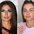 Bivša učesnica rijalitija ostala bez nosa? Turpijali i slomili ga, ona dobila infekciju: Sada ovako izgleda