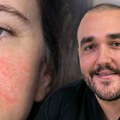Stop kapilarima oko nosa, na obrazima i bradi: Savremeni tretmani koji dubinski obnavljaju kožu i vraćaju joj miran izgled