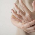 Inovativne terapije i lekovi za lupus nisu jednako dostupni svim pacijentima