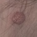 Kada mladež nije bezazlen: znakovi zbog kojih treba odmah kod dermatologa