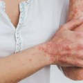 Svetski dan borbe protiv psorijaze: Bolest koja se može kontrolisati, važni pregledi kod dermatologa