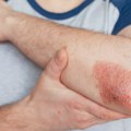 Evropska nedelja borbe protiv psorijaze: Bolest koja pogađa 140.000 osoba u Srbiji