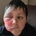 Dečak zadobio teške opekotine zbog TikTok trenda: Sprljio pola lica i šake, ideju mu dao drugar iz škole (foto)