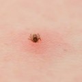 Ujed krpelja – Kako prepoznati simptome lajmske bolesti?