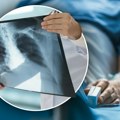 Ko će sve dobiti novu terapiju za rak pluća: Od 1. oktobra dobiće je 3 grupe obolelih, a na proleće još jedna