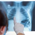 SZO: Tuberkuloza prošle godine ubila 1,23 miliona ljudi