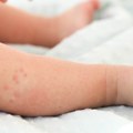 Osip od vrućine kod beba: Kako nastaje i kako zaštititi najmlađe tokom letnjih dana
