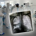 Misteriozna bolest iz kine stigla u Evropu: Pogađa pluća, daje atipične simptome, a posebno kosi decu