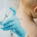 Potvrđene male boginje u Srbiji: Lekari apeluju na potpunu imunizaciju za zaštitu dece