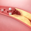 Tri simptoma zapušenih arterija i visokog holesterola