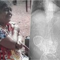 Žena nosila kalcifikovani fetus 56 godina u stomaku Otišla na operaciju da joj ga uklone i umrla